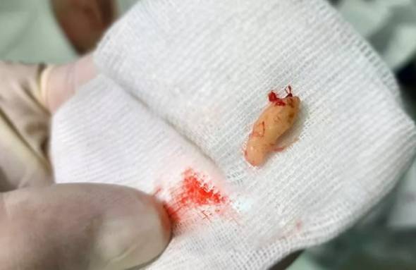 В Иркутске врачи удалили из носа девочки выросший там зуб 