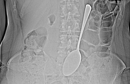 Жительница Бурятии проглотила ложку длиной 18 см 