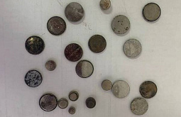 В Улан-Удэ врачи извлекли монету из пищевода ребёнка