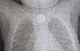 В Бурятии годовалый ребёнок проглотил батарейку и монету 