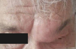 В Бурятии мужчину с огромной кистой на лбу спасли от смерти