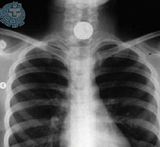 Из пищевода 10-летнего улан-удэнца извлекли монету