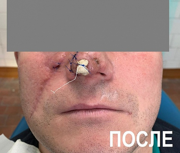 В Улан-Удэ собака откусила мужчине нос